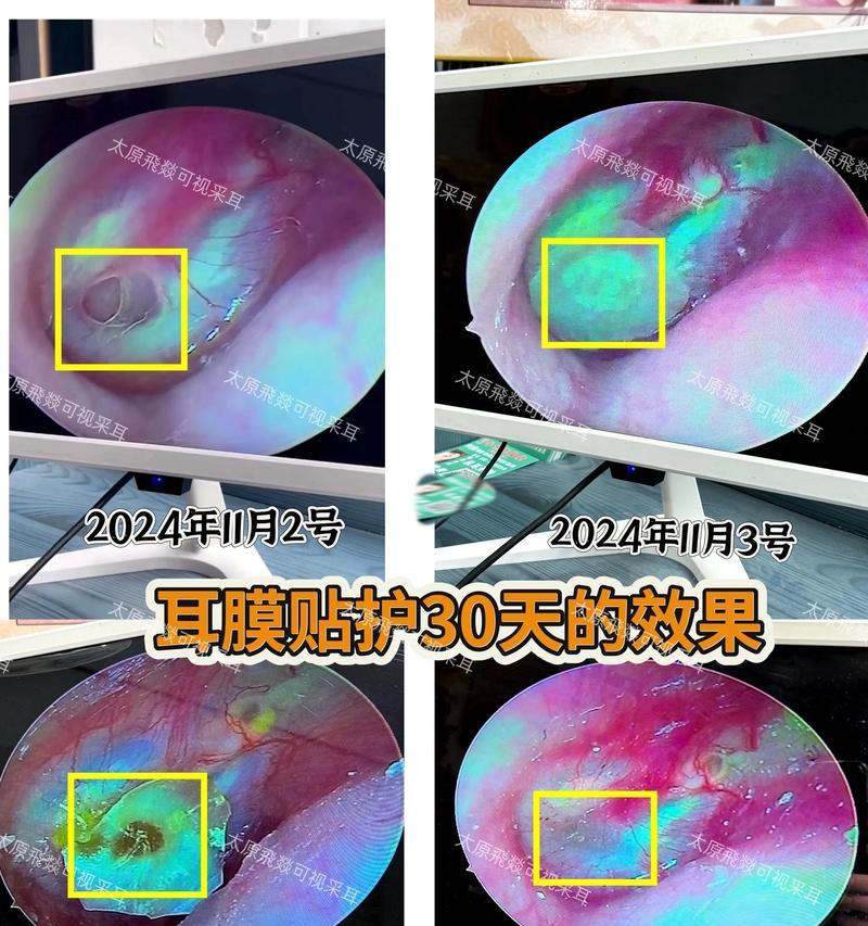 音响鼓膜怎么清理视频？清理鼓膜的正确方法是什么？